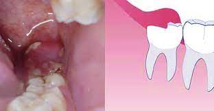Tooth Abscess Problem Question, Wisdom Teeth Problems Chatting, Dental Care Help for tooth infection